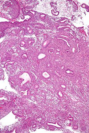 Simple endometrial hyperplasia - intermed mag.jpg