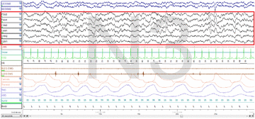 Stage 3 Sleep. EEG highlighted by red box.