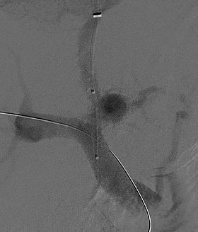 Fluoroscopic image of transjugular intrahepatic portosystemic shunt (TIPS) in progress.jpg