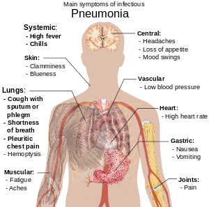 Illustration of pneumonia symptoms on a human body