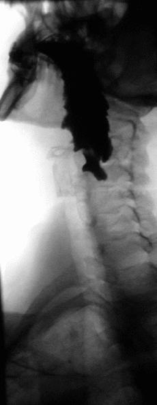 ZenkerSchraeg.gif