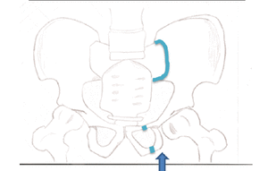 This fracture is best viewed anteriorly, while the other fractures are viewed superiorly. The arrow indicates where the force is coming from, and the colored lines indicate where the break occurs.