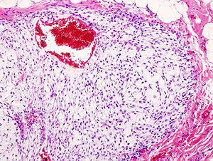 Chondrosarcoma (1).jpg