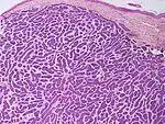 SkinTumors-P6180318.JPG