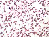 Sickle Cell Blood Smear.JPG