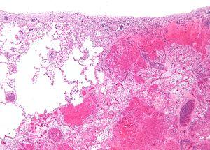 Pulmonary infarct intermed mag.jpg