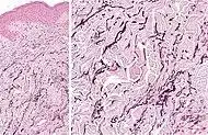 Histopathology of linear focal elastosis.jpg
