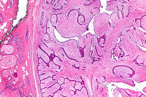 Phyllodes tumour - very low mag.jpg