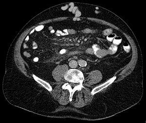 Caput medusae CT ax 002.jpg
