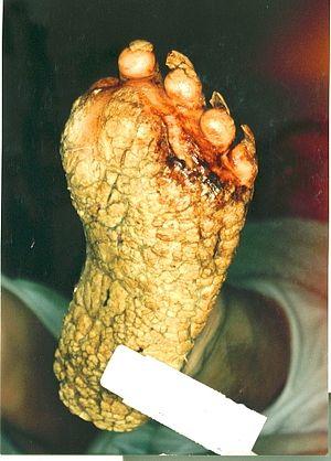Plantarkeratosis-01.jpg