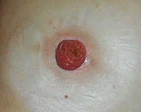 Ileostomy 2017-02-20 5349.jpg