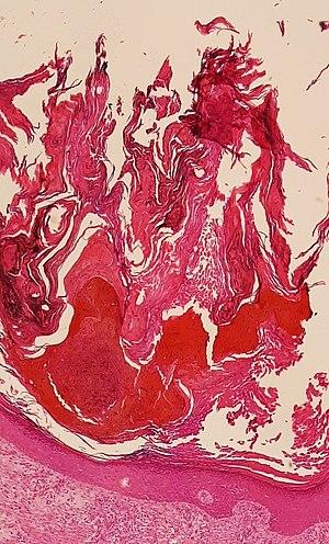 Prominent hyperkeratosis.jpg