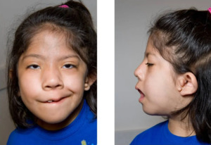 Goldenhar syndrome.png