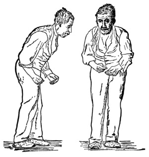 Two sketches (one from the front and one from the right side) of a man, with an expressionless face. He is stooped forward and is presumably having difficulty walking.