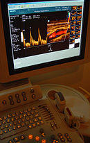 CarotidDoppler1.jpg