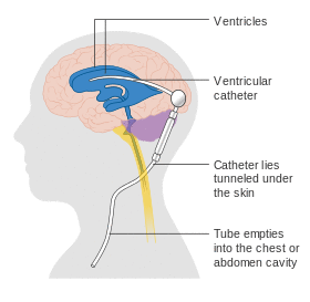 Diagram showing a brain shunt CRUK 052.svg