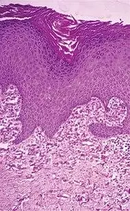 Histopathology of perforating calcific elastosis.jpg