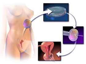 Blausen 0060 AssistedReproductiveTechnology.png