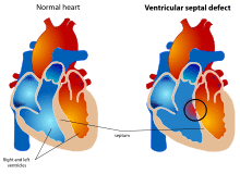 Ventricular septal defect.svg