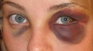 Black eye 2.jpg