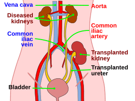 Kidtransplant.svg