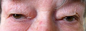 Dermatochalasis.jpg