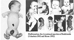 Thalidomide effects.jpg