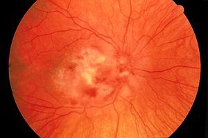 Fundus photograph-CMV retinitis EDA07.JPG