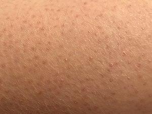 Keratosis pilaris (moderate).jpg