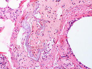 Amniotic fluid embolism.jpg