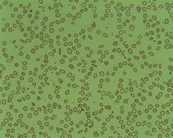 Microcytosis.jpg