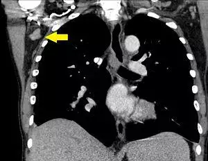 CT of axillary lymphadenopathy - annotated.jpg