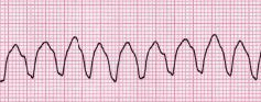Lead II rhythm ventricular tachycardia Vtach VT (cropped).JPG