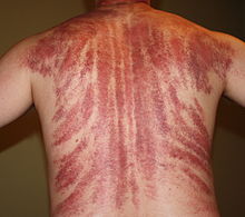 Gua Sha Massage Aftermath.jpg
