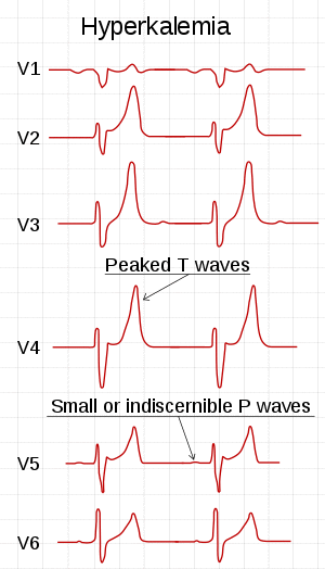 ECG in hyperkalemia.svg