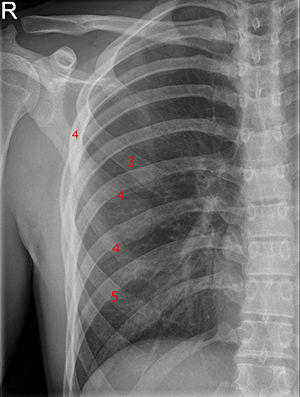 Gabelrippe C4 rechts im Roentgen - Annotation.jpg