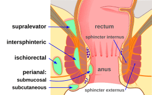 Abscess diag 02.svg
