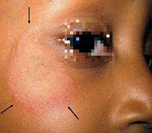 Mycose peau glabre - Dermatophytosis.jpg
