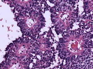 Astroblastoma HE Specimen.jpg