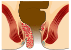 Piles Grade 3.svg
