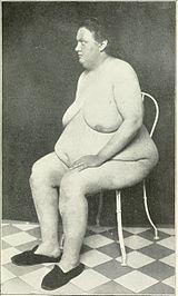 Naked woman with lipomatous Frohlich's syndrome.jpg