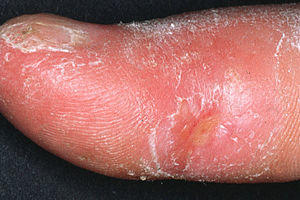 Systemic sclerosis finger.jpg