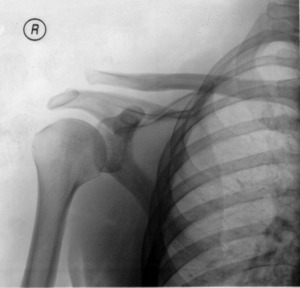 AC Separation XRAY (enhanced).png
