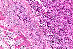 Osteosarcoma - intermed mag.jpg