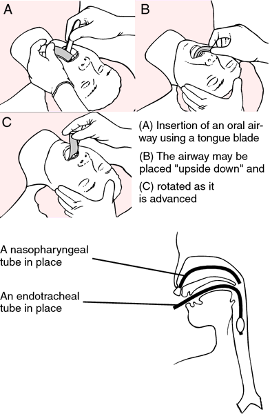 oropharyngeal airway and nasopharyngeal airway