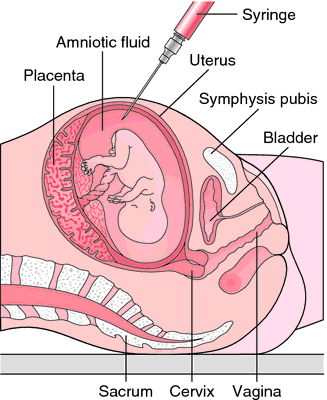 amniocentesis diagram