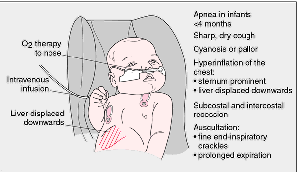 bronchiolitis