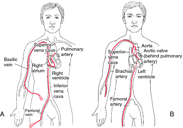 Cardiac Arrest Definition Of Cardiac Arrest By Medical Dictionary