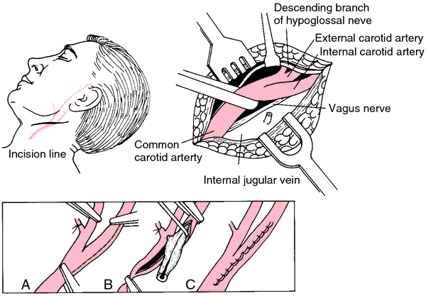 Carotid Sinus Syndrome Definition Of Carotid Sinus Syndrome By Medical Dictionary