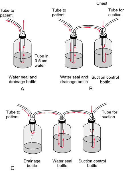 Chest tube | definition of chest tube by Medical dictionary